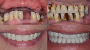 10 Essential Tips for Effective Denture Repair: Safeguarding Your Smile with Mouth Guards